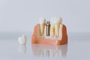 Aké sú spôsoby náhrady za chýbajúci zub?